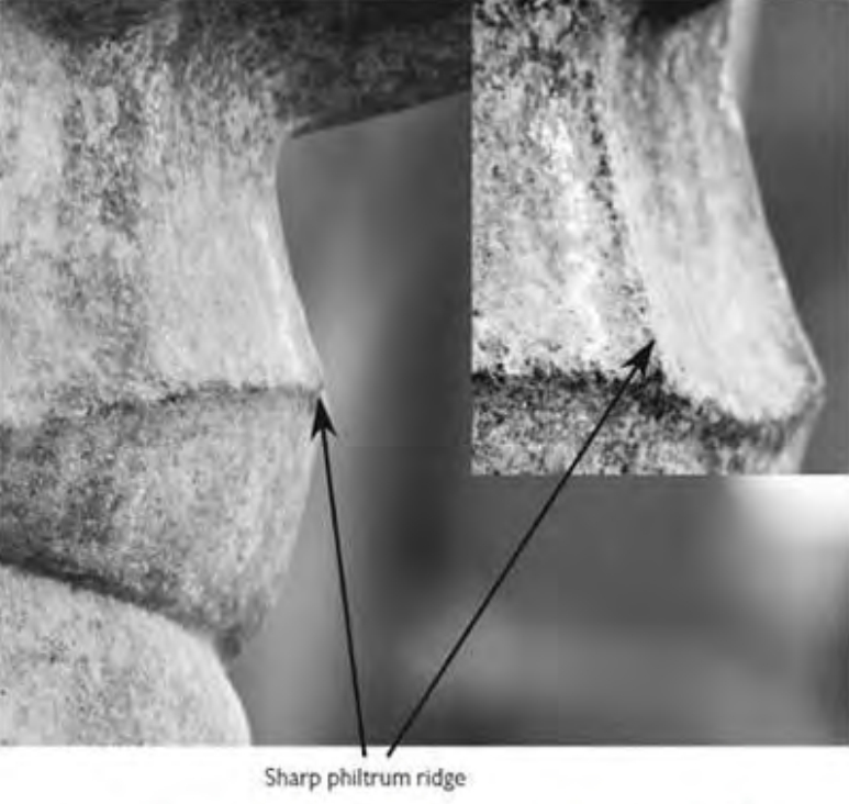 Figure 3.13. Tool marks on Ramses’ mouth